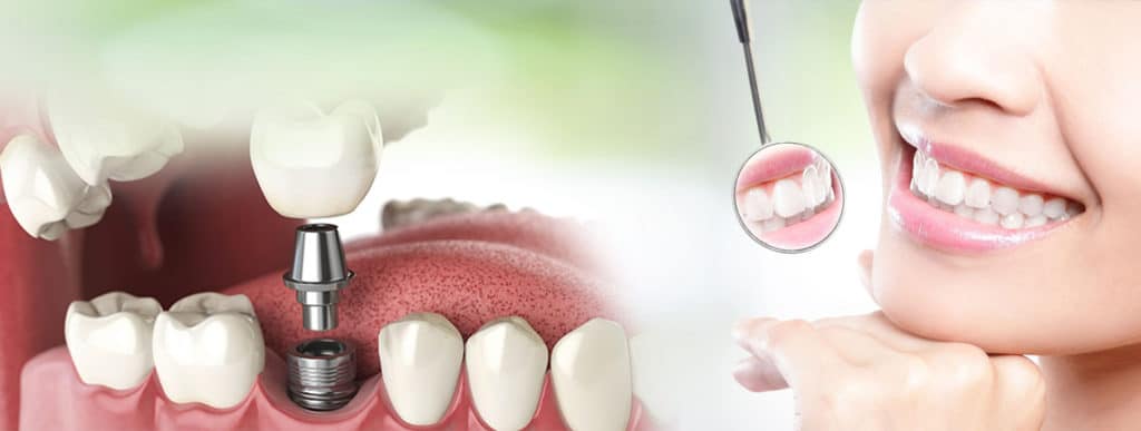 A woman holding a dental implant and a tooth, ready for a dental procedure.