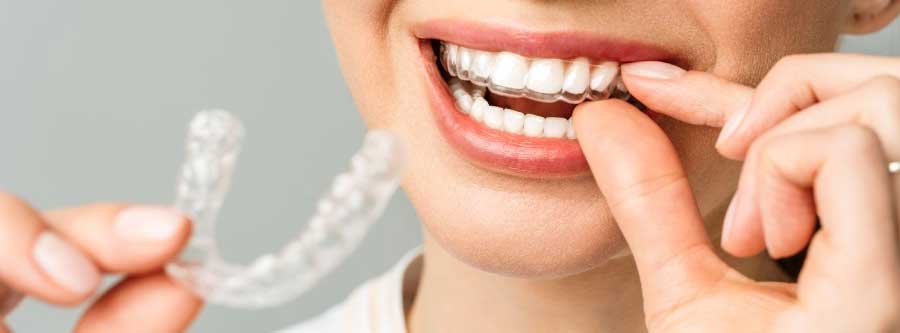 A woman holding a lower teeth Invisalign aligner while plucking up another Invisalign aligner, ensuring proper oral hygiene and aligning her teeth.