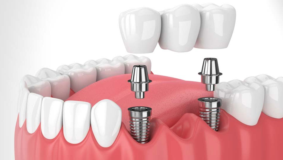 Anatomical model showing dental implants placed in the jawbone, illustrating their function.
          