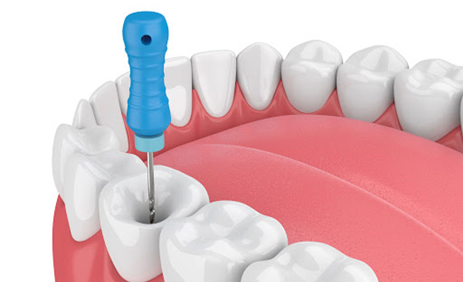 A magnified view of a tooth with dental instruments, representing root canal treatment at an Indore dental clinic.
          